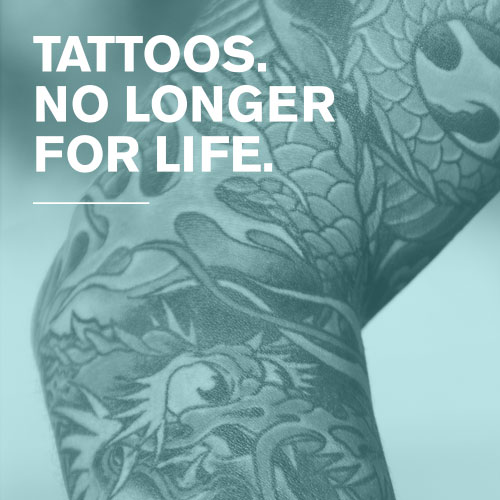 Tattoo Removal in Auckland  Christchurch  Sacred Laser
